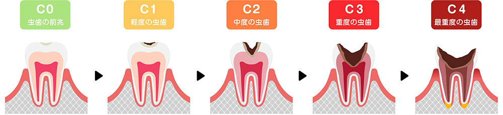 むし歯の痛みは進行が進んでいるサイン