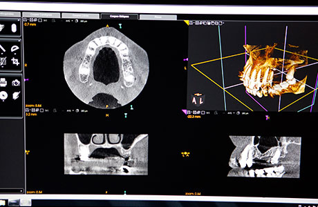 歯科用CTによる精密な診断