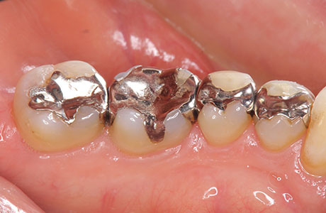 銀歯のリスク