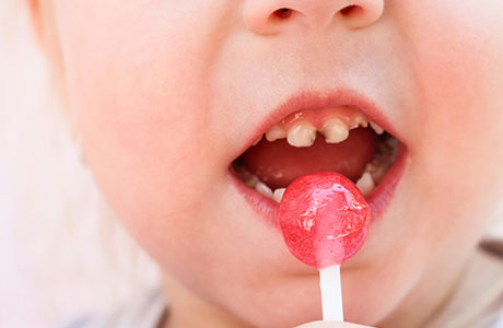 乳歯のむし歯を放置するリスク