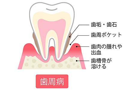 歯周病になる原因