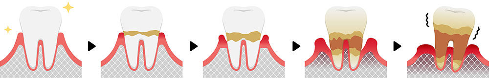 歯周病になる原因