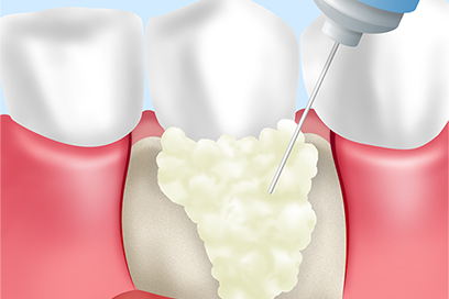 歯周組織再生療法